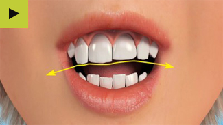 Gum Contouring & Teeth Reshaping